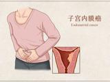 绝经后出血，警惕妇科肿瘤！